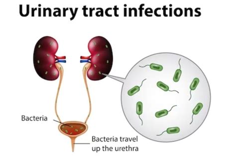 What Helps With Urinary Tract Infections