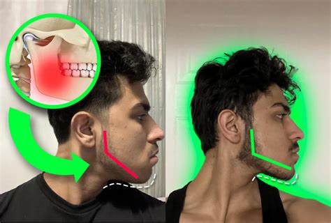 What Improves Jawline