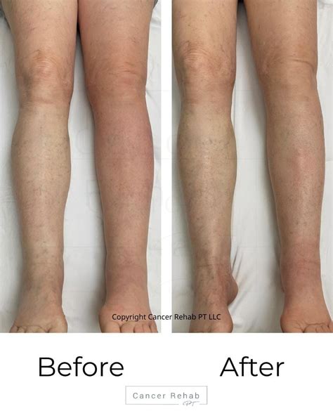 What Improves Lymphatic Drainage