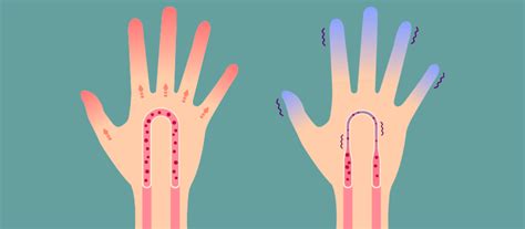 What Improves Poor Circulation