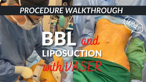 What Is A Bbl Procedure