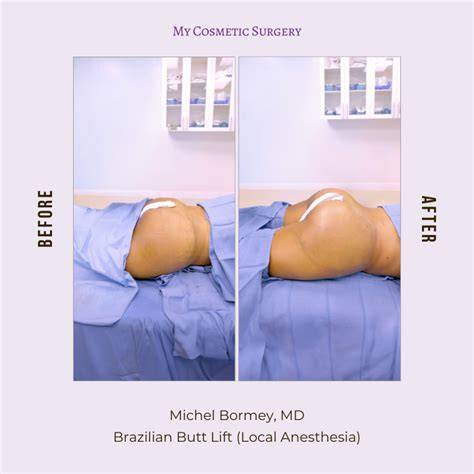 What Is A Bbl Surgery