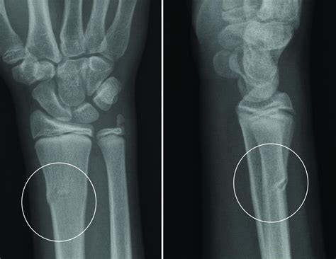 What Is A Buckle Fracture