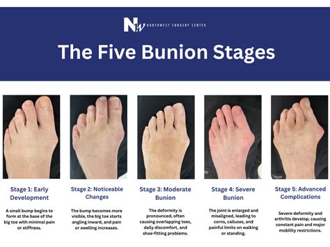 What Is A Bunion