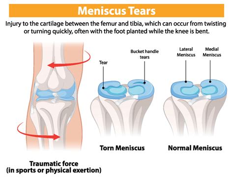 What Is A Meniscus