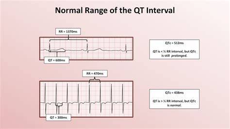 What Is A Normal Qtc