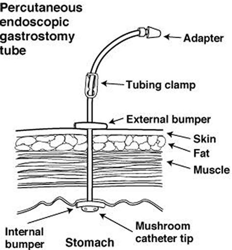 What Is A Peg Tube