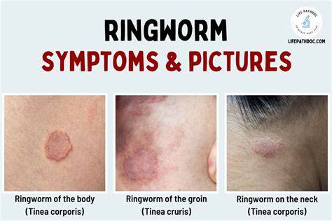 What Is A Ringworm