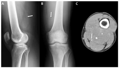 What Is A Sarcoma