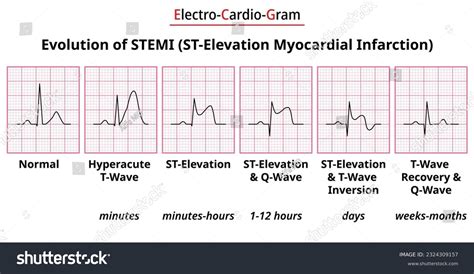 What Is A Stemi