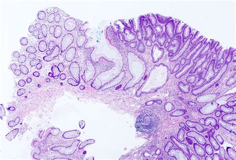 What Is A Tubular Adenoma