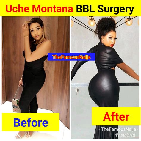 What Is Bbl Surgery