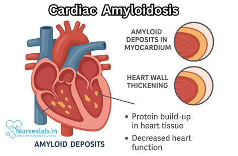 What Is Cardiac Amyloidosis