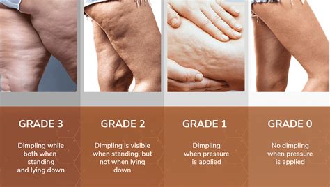 What Is Cellulite