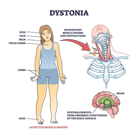 What Is Cervical Dystonia