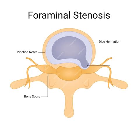 What Is Foraminal Stenosis