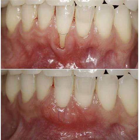 What Is Gum Graft Surgery