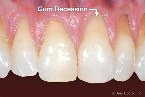 What Is Gum Recession