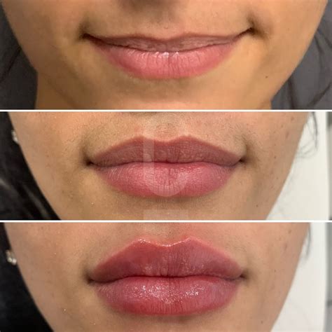 What Is Lip Filler