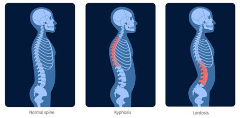What Is Lordosis