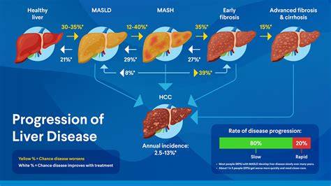 What Is Mash Liver Disease