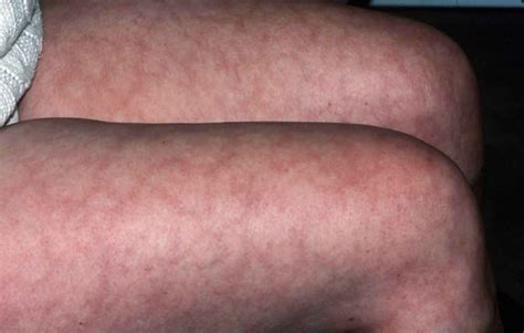 What Is Mottled Skin