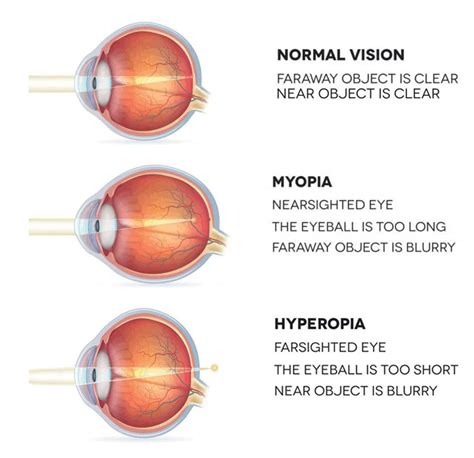What Is Nearsighted
