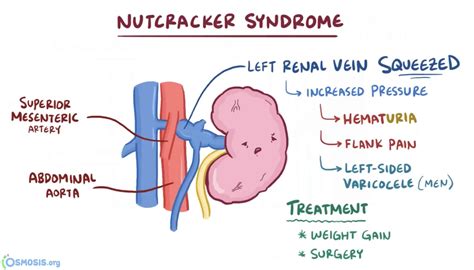 What Is Nutcracker Syndrome