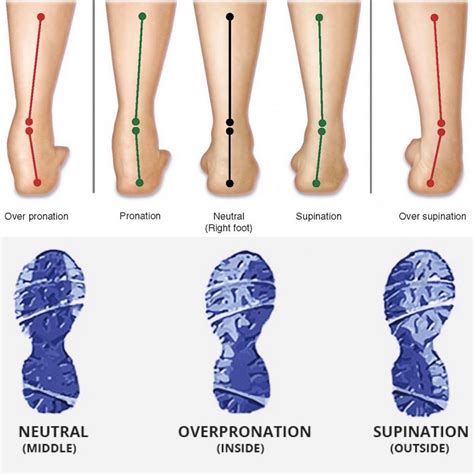 What Is Overpronation