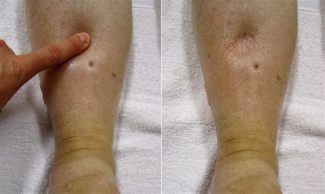 What Is Pitting Edema
