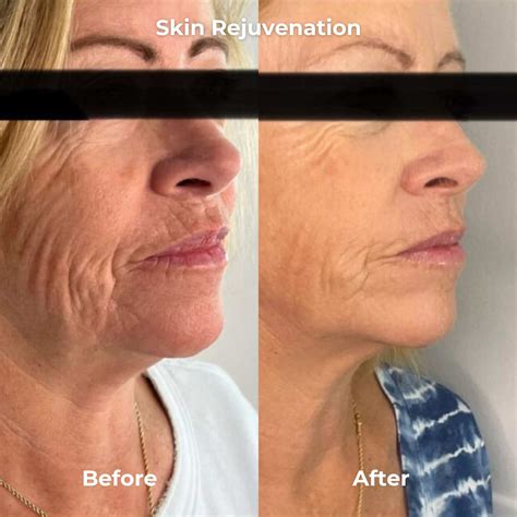 What Is Rf Microneedling