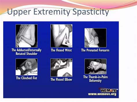 What Is Spasticity