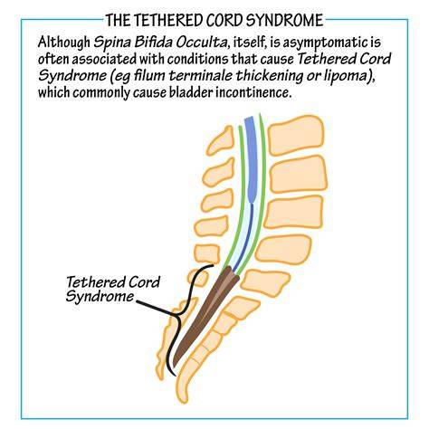 What Is Tethered Cord Syndrome