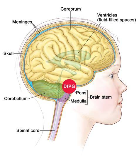 What Is The Disease Dipg