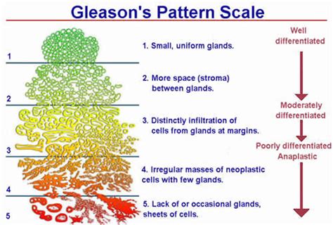What Is The Gleason Score