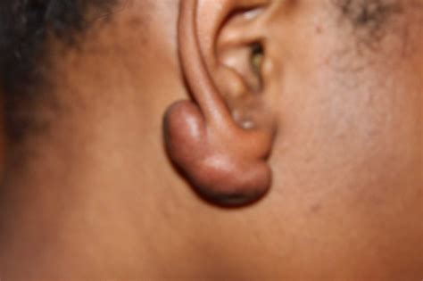 What Is The Keloid