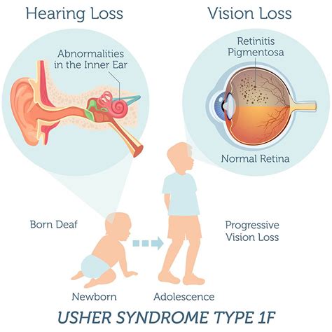 What Is Usher Syndrome