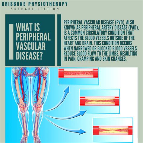 What Is Vascular Disease