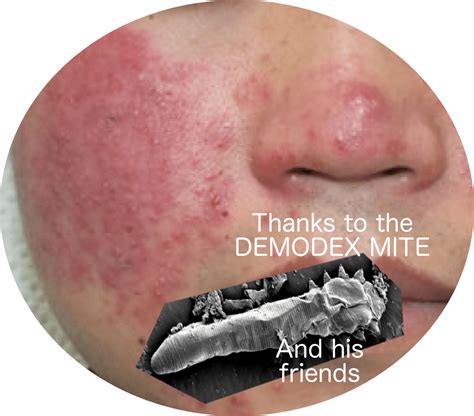 What Kills Demodex Mites