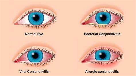 What Kills Pink Eye On Surfaces