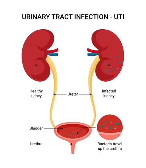 What Kills Urinary Tract Infection