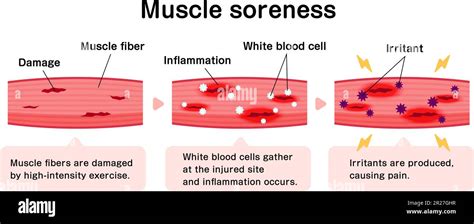What Makes Muscles Sore