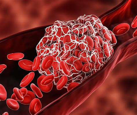 What Prevents Blood Clots