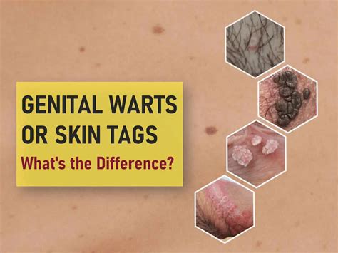 What Prevents Genital Warts