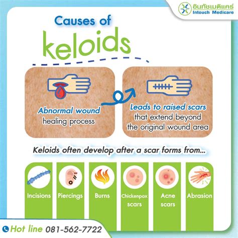 What Prevents Keloids