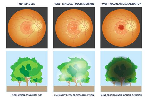 What Prevents Macular Degeneration