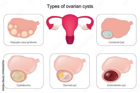 What Prevents Ovarian Cysts