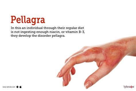 What Prevents Pellagra