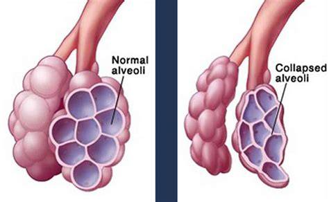 What Prevents The Alveoli From Collapsing