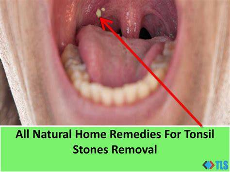What Prevents Tonsil Stones